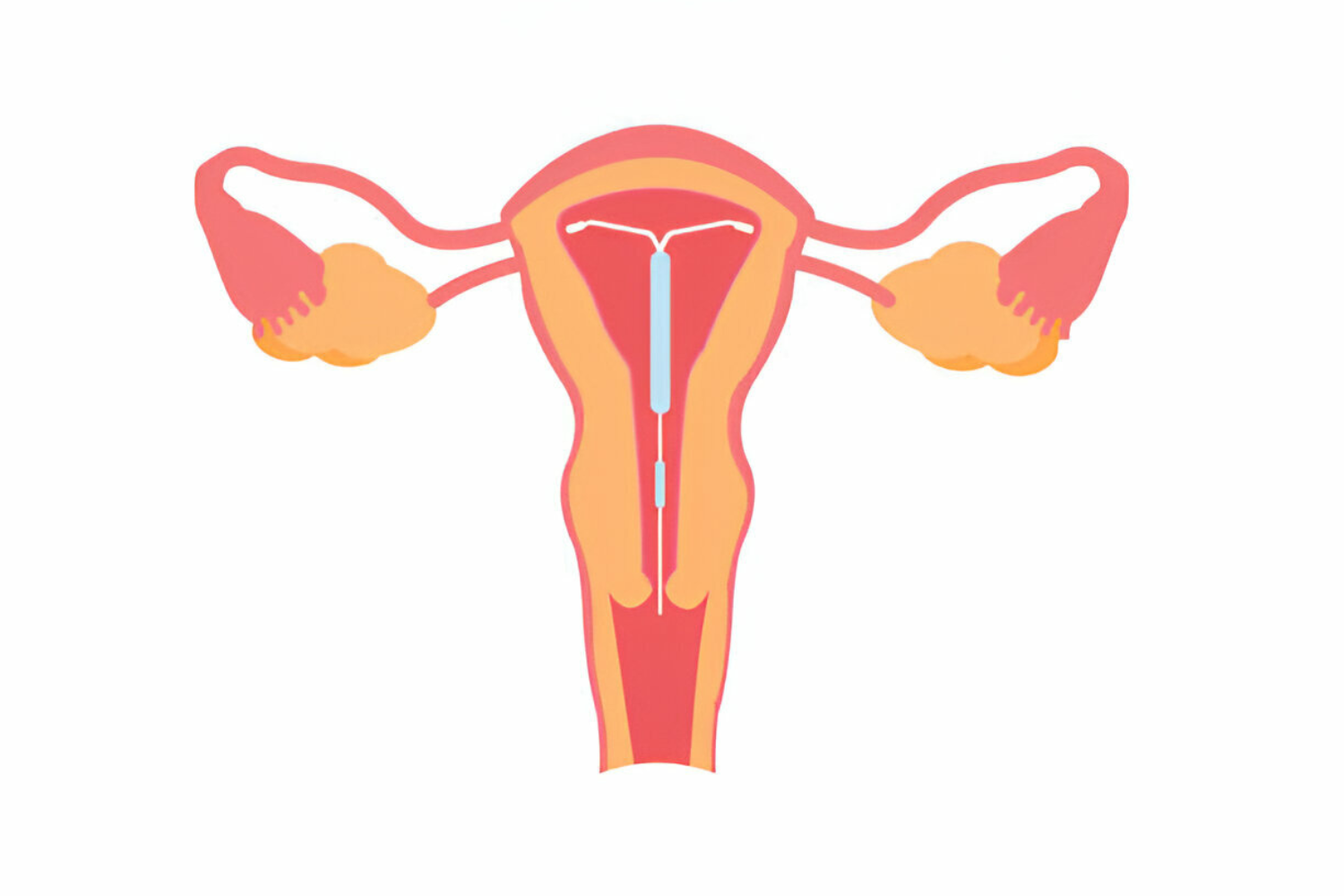 Mirena Insertion | Hormonal Intrauterine Device Insertions in Kalyani Nagar, Pune